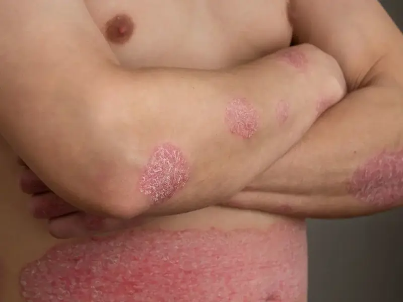 sedefhastaligipsoriasis.webp