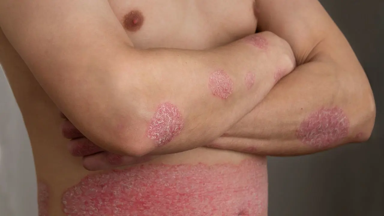 sedefhastaligipsoriasis.webp